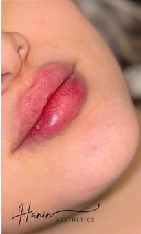 Lip enhancement after treatment