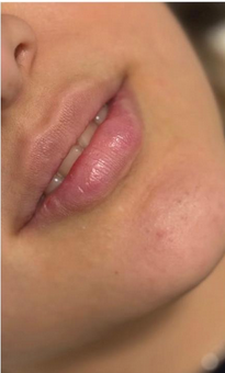 Lip enhancement before treatment