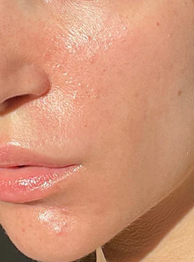 Skin glow treatment after